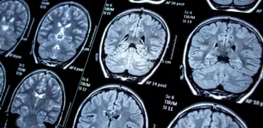 Ваш мозок на продаж: чому дані нейроактивності можуть стати новим об'єктом спекуляцій